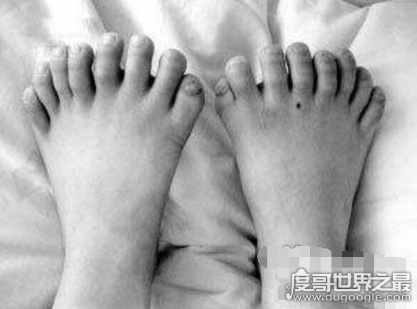 世界上脚趾最多的人，印度小男孩脚趾数量多达20根