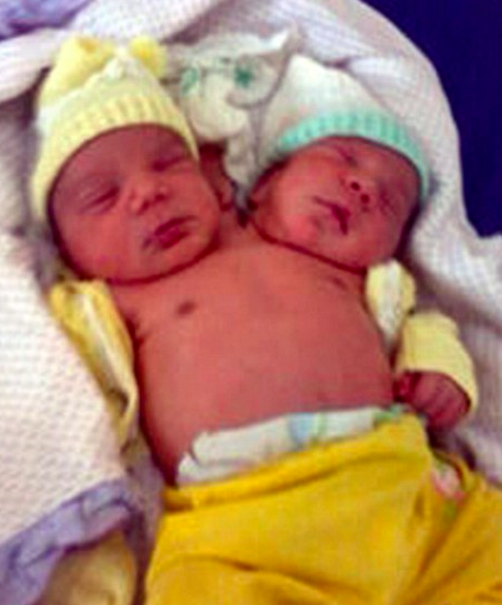 巴西双头婴儿，2012年出生的世界罕见神奇婴儿（身体健康）