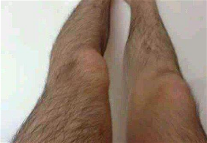 世界上最长的腿毛 长到了22.46厘米(杰森·艾伦)