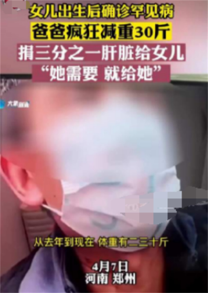 父亲3个月减掉30斤割肝救女 已配型成功