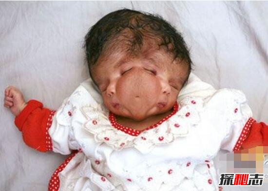澳大利亚怪婴之谜，女子产下双面婴儿(两张脸/一个身体)