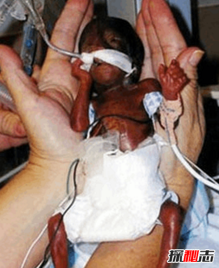 世界上最小的婴儿阿米利娅·泰勒,仅280克(现状揭秘)