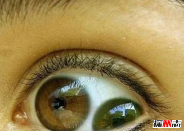 什么是双瞳孔?世界上有双瞳孔的人吗?(中国史书记载共八人)