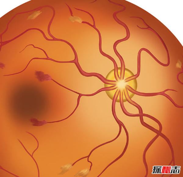 过山车致严重眼病?武汉大学生玩过山车致视网膜脱落(700度近视)