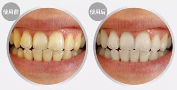 冷光美白牙齿副作用有哪些?冷光美白牙齿后悔了真的吗