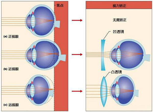 远视眼有隐形眼镜吗?远视眼隐形眼镜在哪里购买