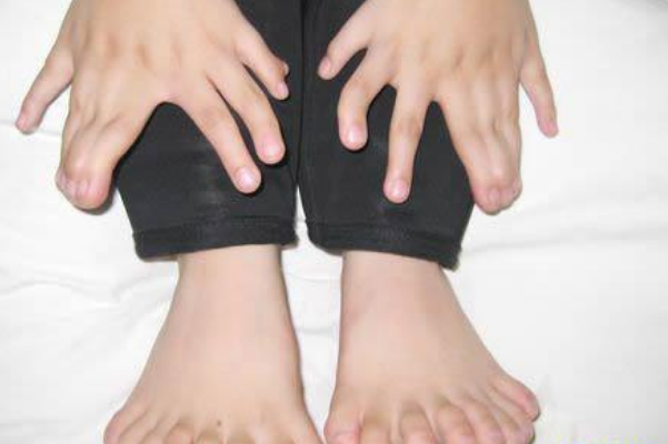 世界上手指脚趾最多的人:印度男孩多指畸形(34根手脚指)