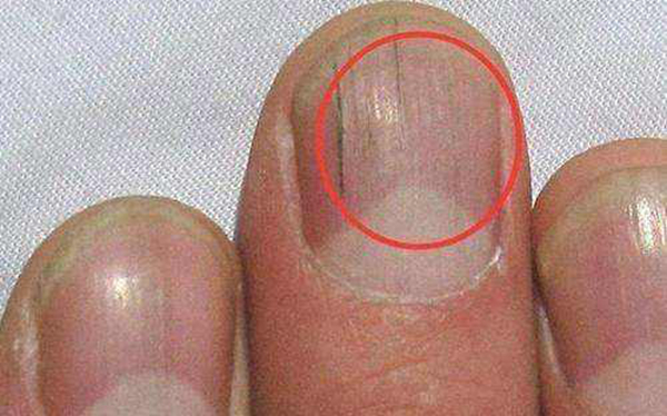 指甲上有横纹是怎么回事?怎样让指甲长得更好