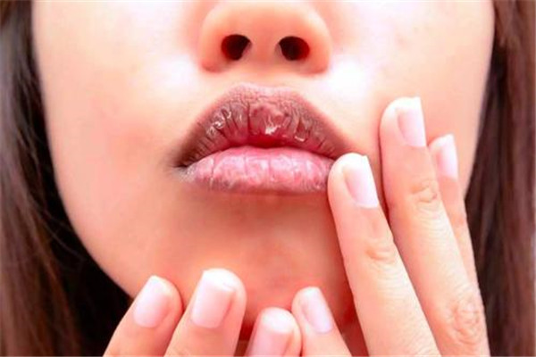 嘴唇干燥吃什么水果好 嘴唇干燥的原因有哪些