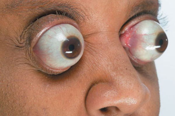 世界上最长的眼球:爆出眼眶达11毫米(像极了外星人)