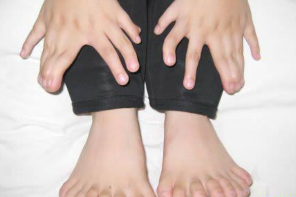 世界手指和脚趾最多的人:共34根(脚趾20根/手指14根)