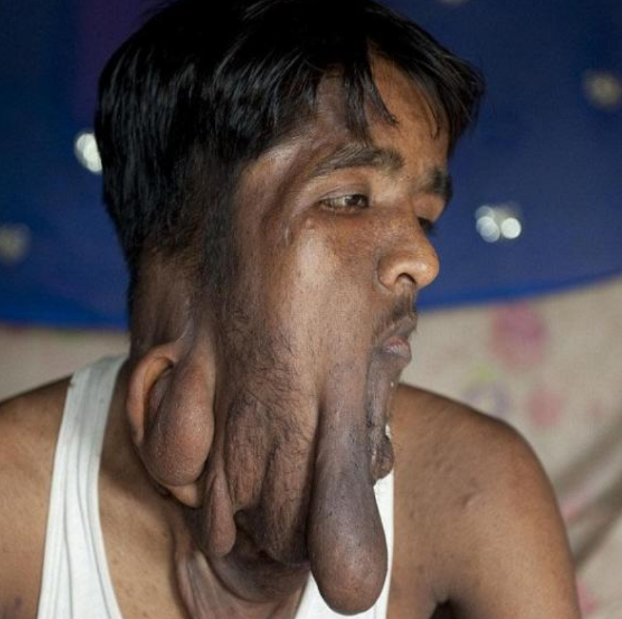 印度男子脸上长满肿瘤 甚至导致双目失明（无脸男）