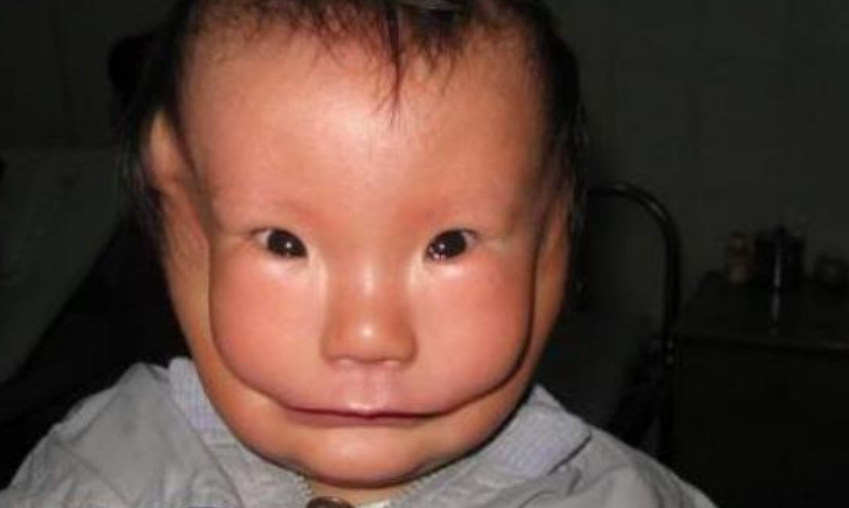 江西女子生下恐怖的婴儿 眼睛看起来像青蛙（畸形婴儿）