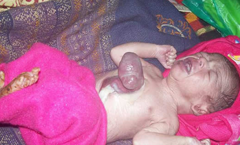 印度一婴儿心脏长在身体之外 居然还能健康生活（特殊婴儿）