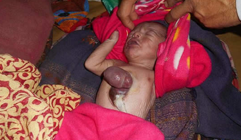 印度一婴儿心脏长在身体之外 居然还能健康生活（特殊婴儿）