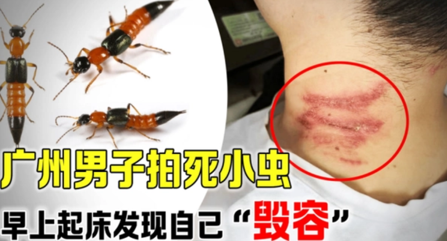 广州男子拍死一只小虫子 醒来之后发现自己毁容（隐翅虫）