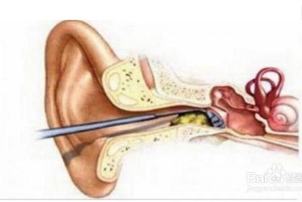 耳屎多是怎么回事？耳屎突然增多或是发病的征兆