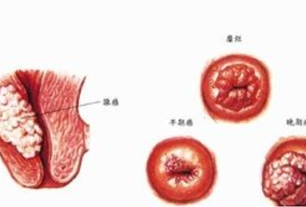 四种癌已经不是癌了：乳腺癌/大肠癌/宫颈癌等（不用太担心）