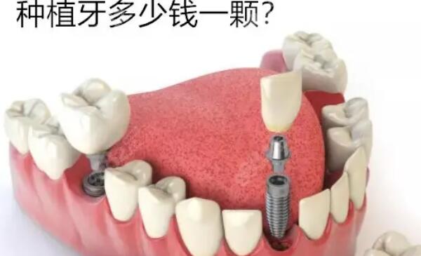种个牙多少钱：一颗牙3000-15000元左右，舒适稳固无痛