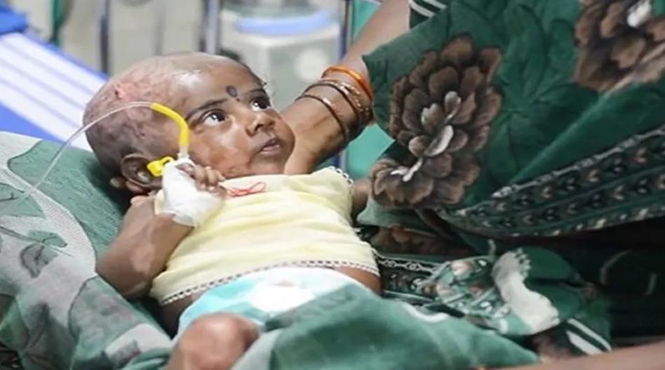 印度男婴出生3个月，离奇自燃了4次 （火神转世）