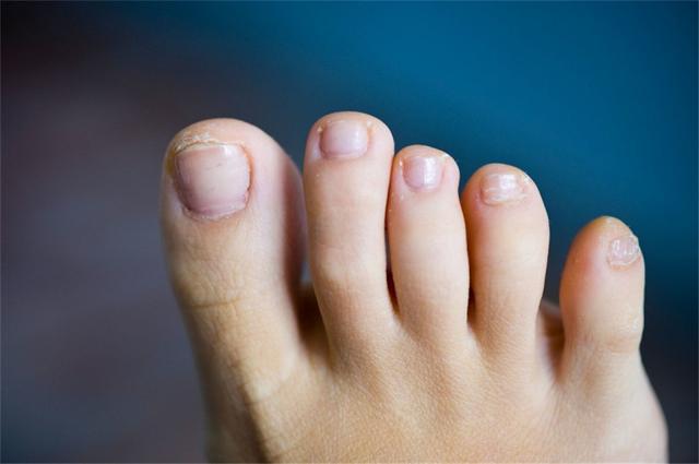 那些小脚趾指甲分成两瓣的人，到底是什么来历（不同的小脚趾）