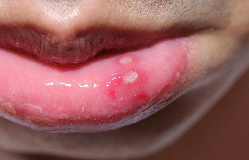 口腔溃疡是不是人类通病 得上口腔溃疡应该怎么办？（常见病症）