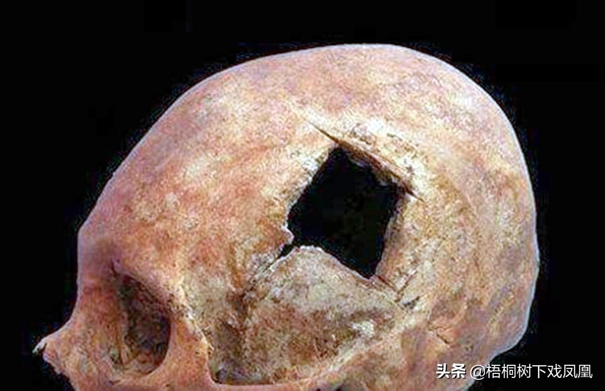 不可思议的史前考古发现，脑袋上有孔是开颅手术，还是吸食人脑？