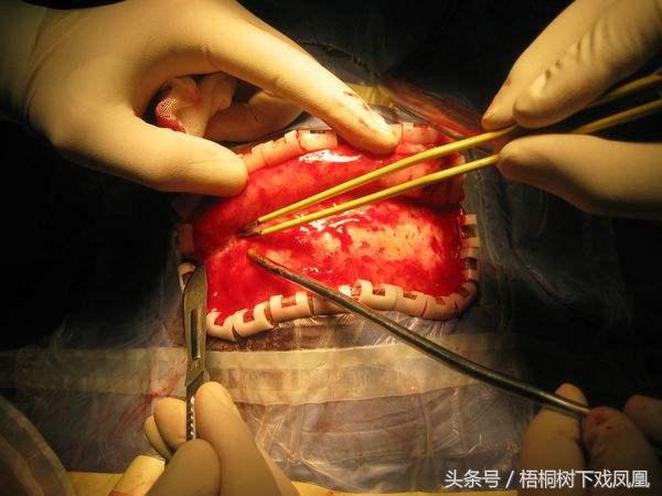 远古人类颅骨上发现外科手术般孔洞，一说开颅治病，一说吸食人脑