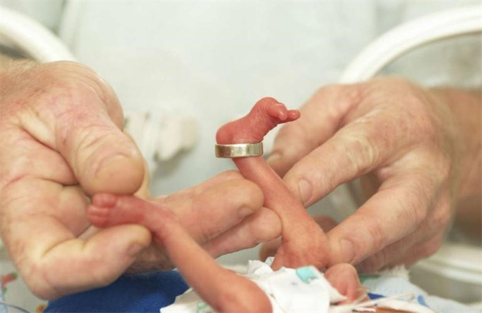 人类最小婴儿  出生时不到1斤  医生说活不过3个月  如今怎么样了
