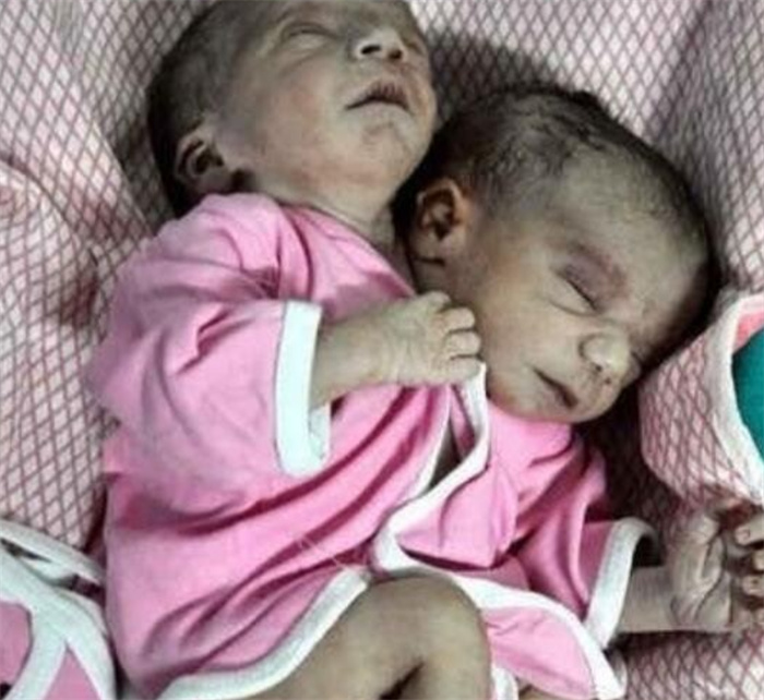 巴西出现的双头婴儿 两个孩子共用一个身体（双头人）