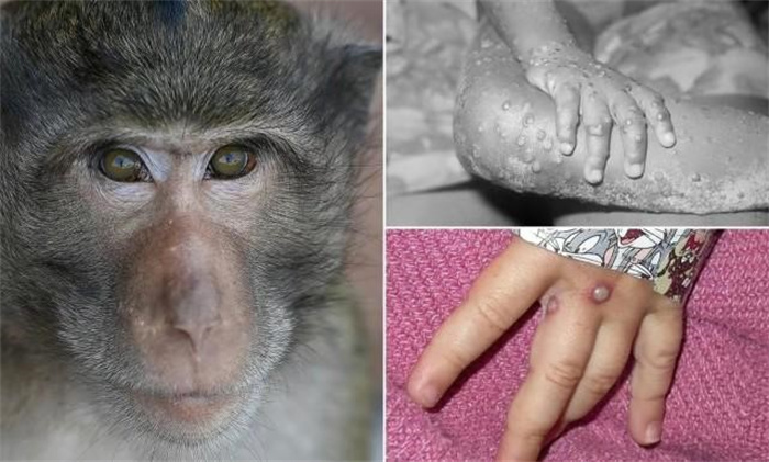 广州发现两例猴痘病例 症状较轻
