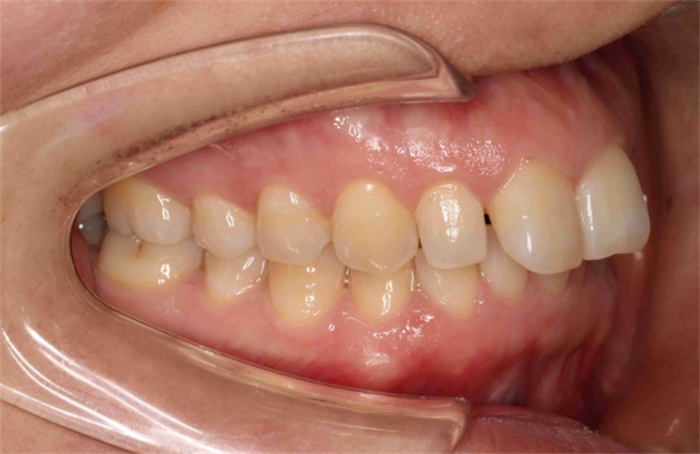 人有多少颗牙齿才算正常 人的牙齿为什么不能再生（32颗）