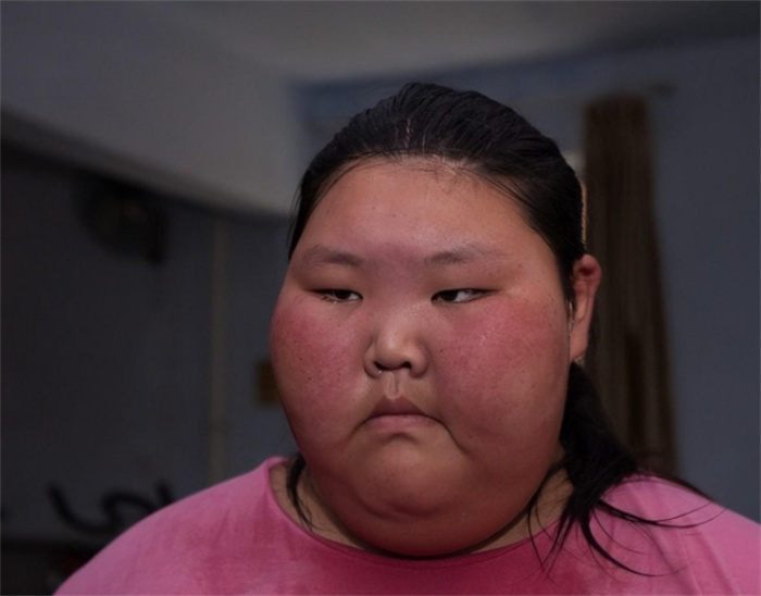 16年，山东16岁女孩重330斤受歧视，1年暴瘦170斤，如今吃到369斤