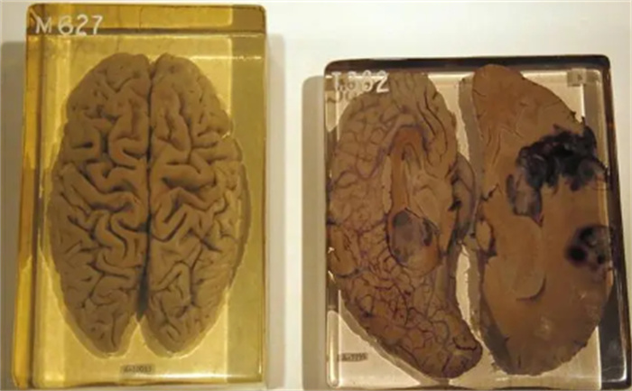 爱因斯坦的大脑 爱迪生的最后一口气 还有收藏的名人器官