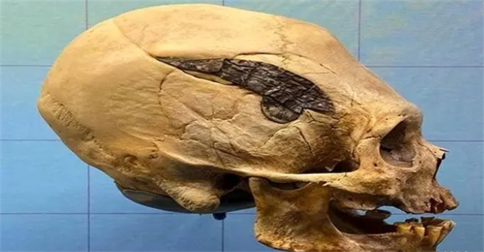 高级古代人：2000岁的头骨怎么可能有金属植入物？
