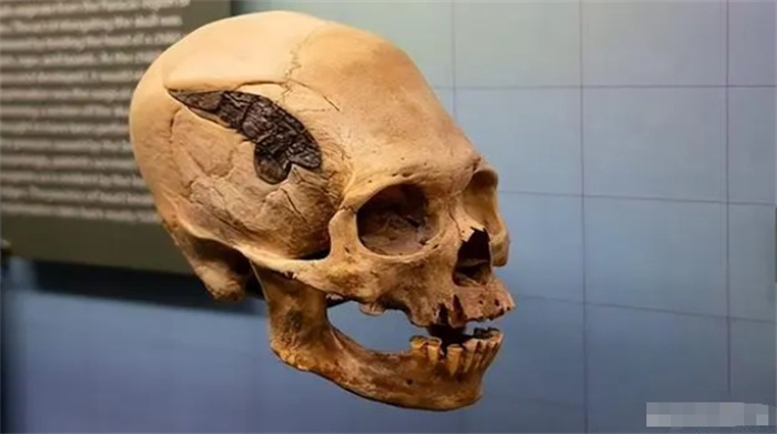 高级古代人：2000岁的头骨怎么可能有金属植入物？